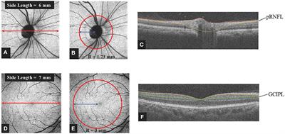 The Detection of Retina Microvascular Density in Subclinical Aquaporin-4 Antibody Seropositive Neuromyelitis Optica Spectrum Disorders